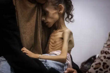  9-jähriges Mädchen aus Gaza wiegt nur noch 10 kg – FOTOS